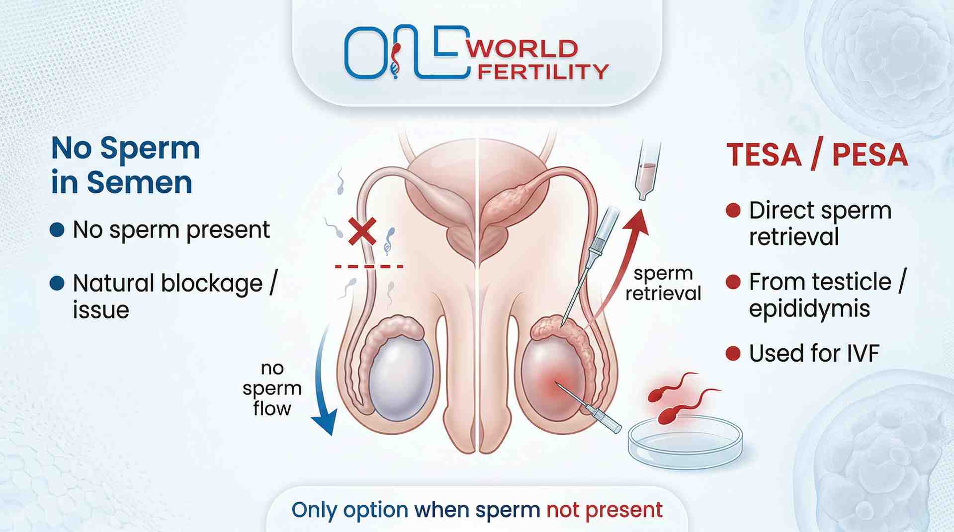 TESA PESA - Getting Sperm Directly from the Body - one world fertility.jpeg